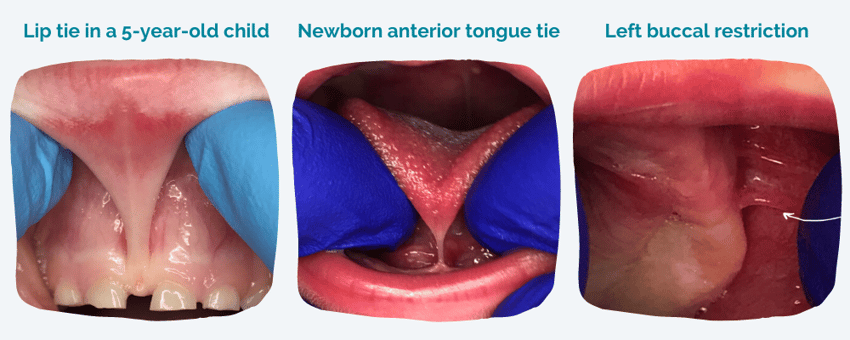 Tongue-lip-buccal-tie (1)